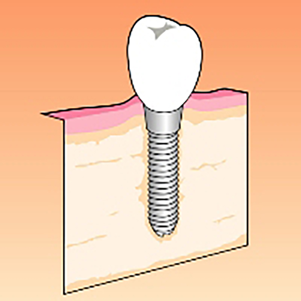 インプラント