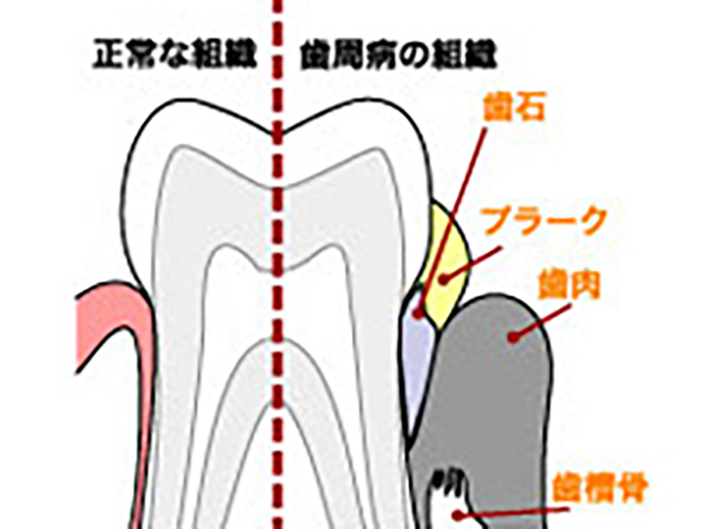 歯周病治療